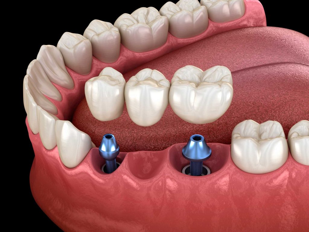 clínica dental en Bravo Murillo I dentistas en Bravo Murillo