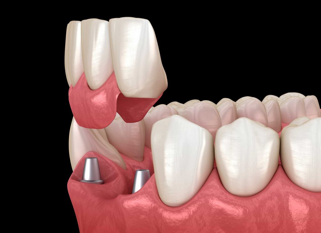 clínica dental en Bravo Murillo I dentistas en Bravo Murillo